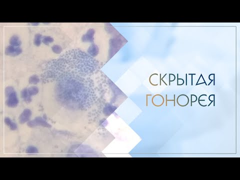 👉 Скрытая гонорея. Клинический случай №51