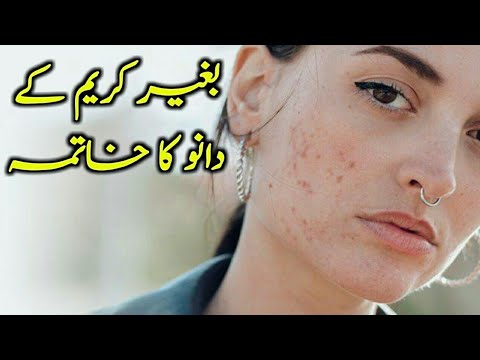 Face Par Dane Khatam Karne Ka Tarika|Best Treatment For Remove Pimple & Acne|Qudrati ilaj