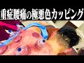 【吸い玉 福岡】ひどすぎる腰痛の視聴者さんに吸い玉してみた！【福岡美容鍼灸サロンCanna】