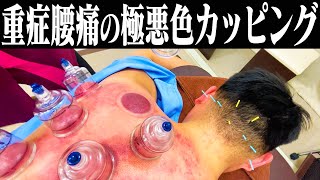 【吸い玉 福岡】ひどすぎる腰痛の視聴者さんに吸い玉してみた！【福岡美容鍼灸サロンCanna】