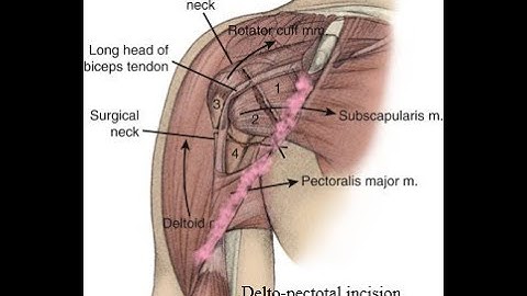 Proximal Humerus Fracture  Open Reduction and Internal Fixation.