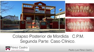COLAPSO POSTERIOR DE MORDIDA. SEGUNDA PARTE. CASO CLÍNICO COLAPSO POSTERIOR DE MORDIDA. SEGUNDA PARTE. CASO CLÍNICO