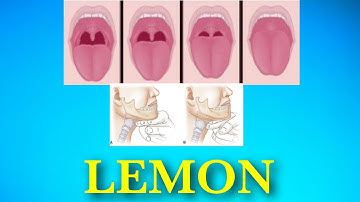 LEMON CRITERIA || AIRWAY ASSESSMENT