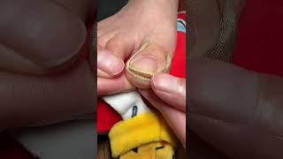 Ingrown Toenail Correction Foot Care Nail Treatment Shorts