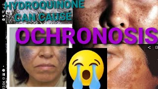 HYDROQUINONE may cause OCHRONOSIS