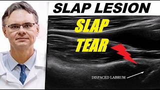 SLAP Tear on Ultrasound — Shoulder Labrum Tear Explained (Normal vs Pathology)