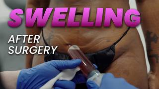 Swelling After Plastic Surgery: What NO ONE Tells You