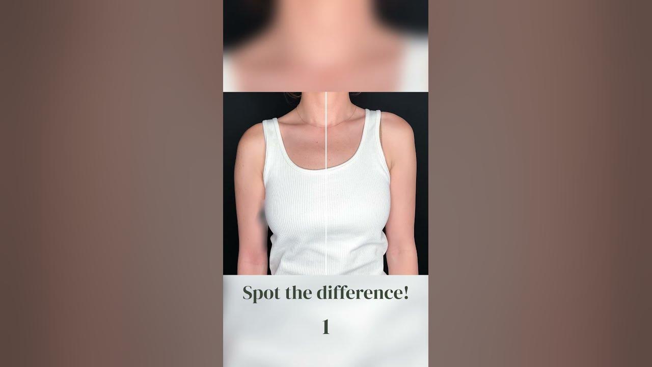 Shoulder contouring with botox injected into the trapezius muscle