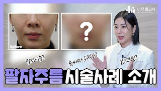 [패션닥터] 팔자주름 실제 시술 전후 케이스로 알려드립니다