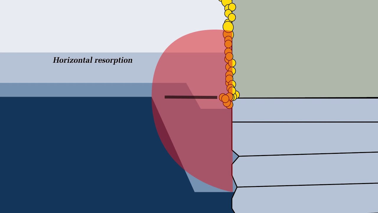 why marginal bone resorption on implants how biological width is formed youtube