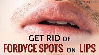 12 Ways To Get Rid Of Fordyce Spots On Lips | Healthspectra