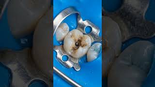 Half Tooth Rebuilt Like Magic 😱🦷 | #dentist #toothcraft #satisfying