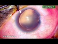 Traumatic Iris defect  repair with Single pass four throw technique @ sharp sight  By Dr Kamal Kapur