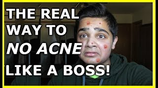 The REAL way to no acne like a BOSS!