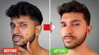 Pimples වලට වසදම. How To Keep Your Face Pimple Free