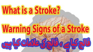 What is a Stroke | Warning Signs of Stroke and Steps to take during the Stroke Attack