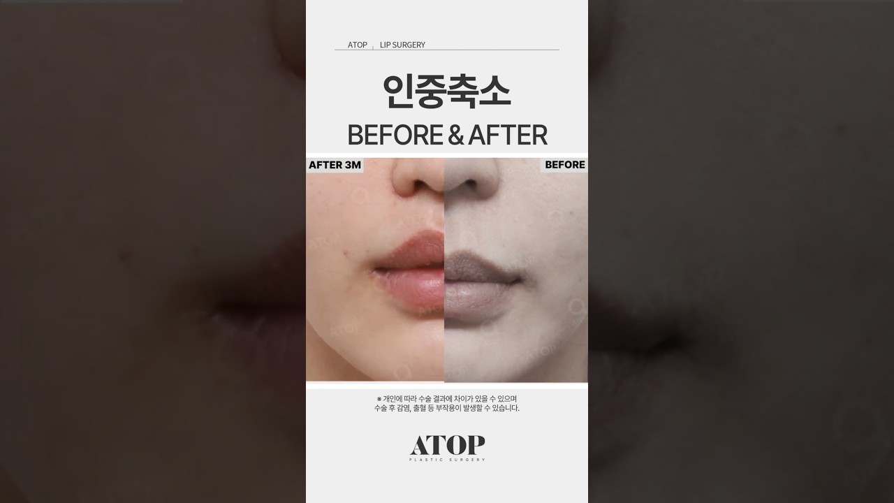 [Thẩm mỹ viện A-TOP] Thu gọn nhân trung_review 1