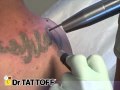 Removal of tattoo  upper back name tattoo removed at dr tattoff laser tattoo removal clinic