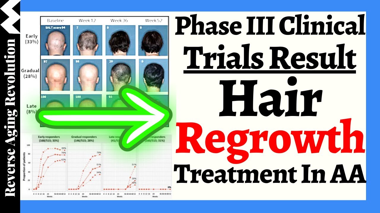 Phase III Clinical Trials Results Revealed Hair Regrowth Treatment in