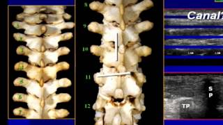 Regional Anesthesia - Sonoanatomy II (Truncal, Spine and Paravertebral Regions)