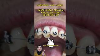 GUSI MEMBESAR SETELAH GIGI YANG SEMBUNYI SUDAH BERHASIL KELUAR | drg. Shanti Yuniwardani