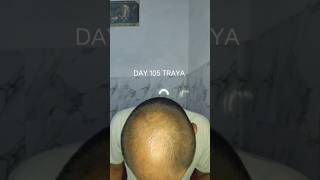 Day 105 traya | hair regrowth journey #shorts #hairregrowth #viralshorts #minoxidil #haircare #hair