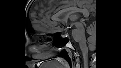 How to read an MRI of the pituitary gland | First Look MRI