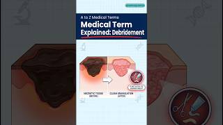 A to Z Medical Terms: Debridement Kya Hota Hai?