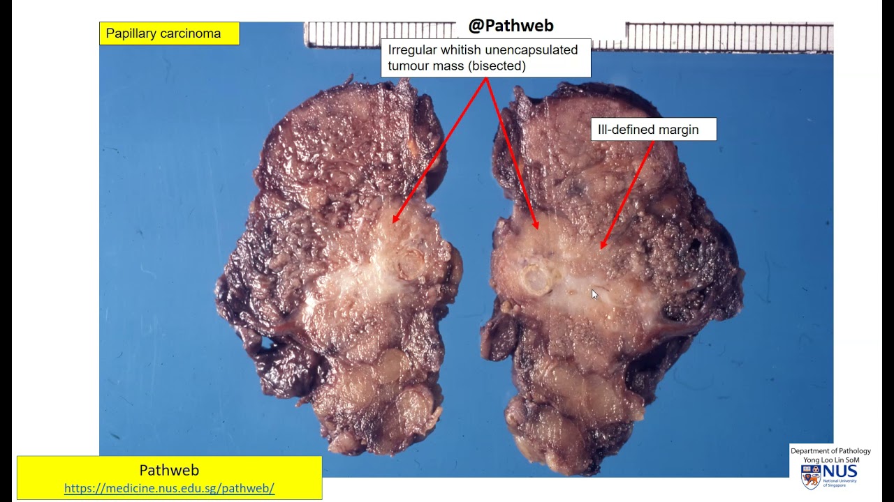 papillary thyroid carcinoma gross