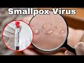 Smallpox Virus kia kaha se ai? Origin of Medical science.
