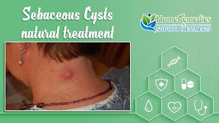 Natural treatments and home remedies for Sebaceous Cysts