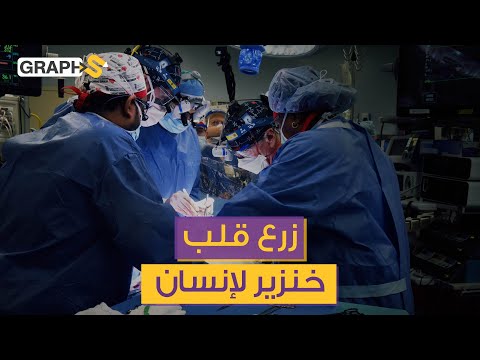 ثورة في عالم الطب نجاح أول عملية زرع قلب خنزير لإنسان