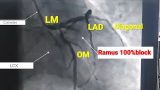 Acute heart attack ll Stenting to Ramus artery ll 100% blocked ramus artery Resimi