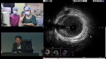 [TCTAP 2017] Coronary Symposium - Live Case & Lecture Session II