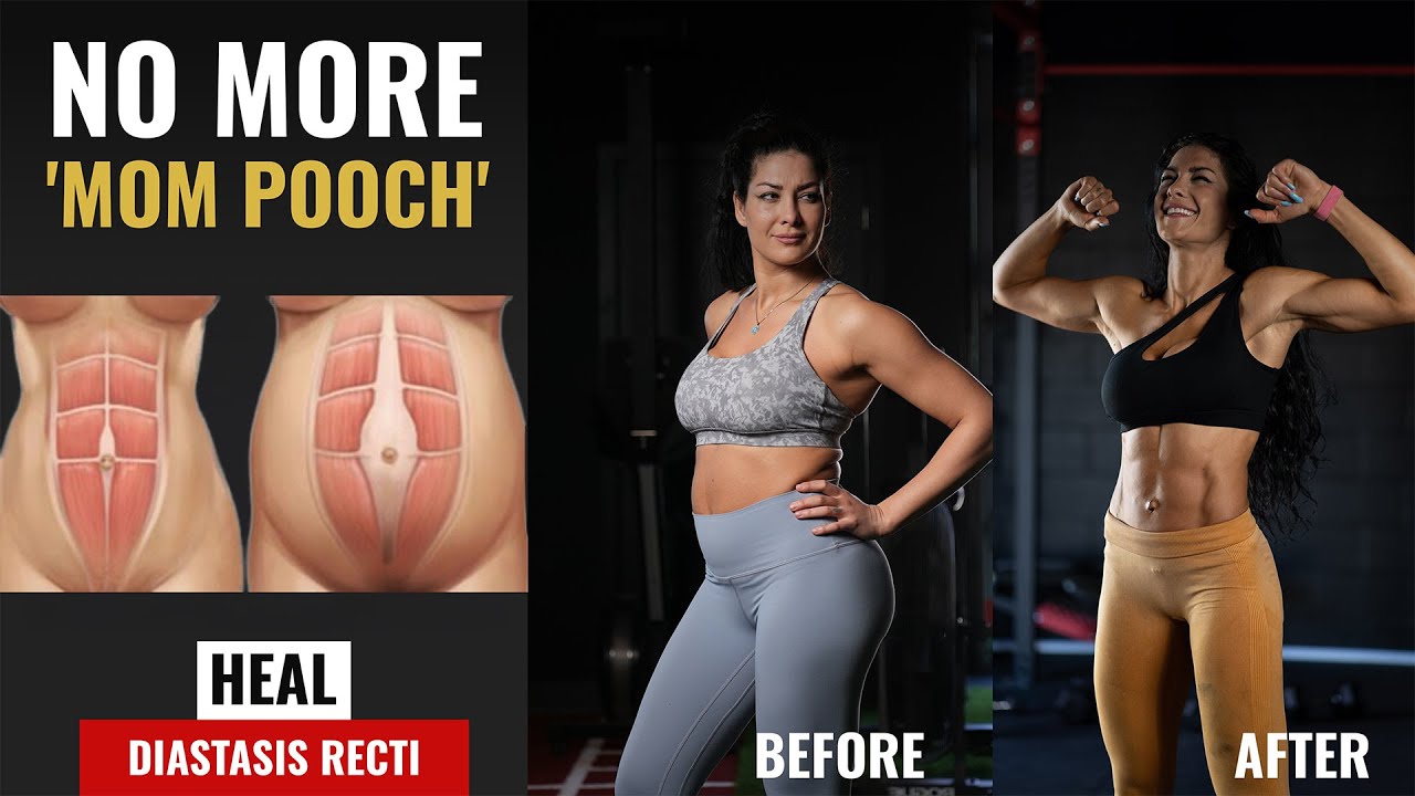 Heal Diastasis Recti | No More 