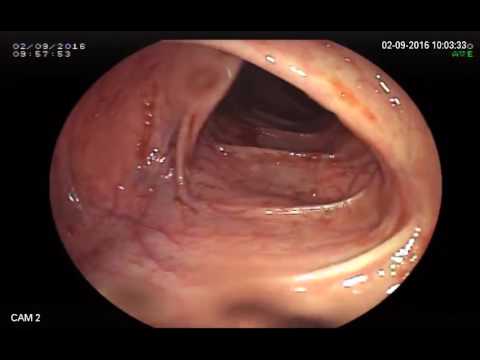 Coloscopie du 02/09/2016 effectuée à Polyclinique Jerba International