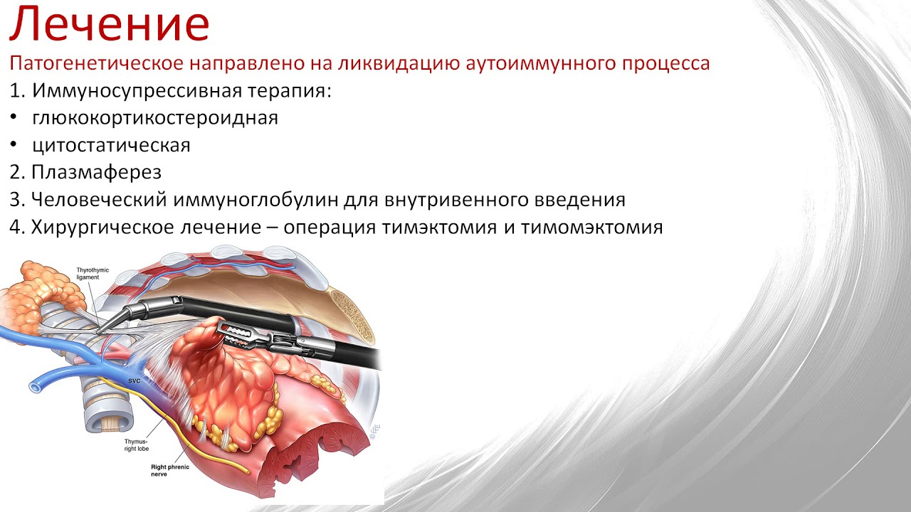 Миастения гравис - YouTube