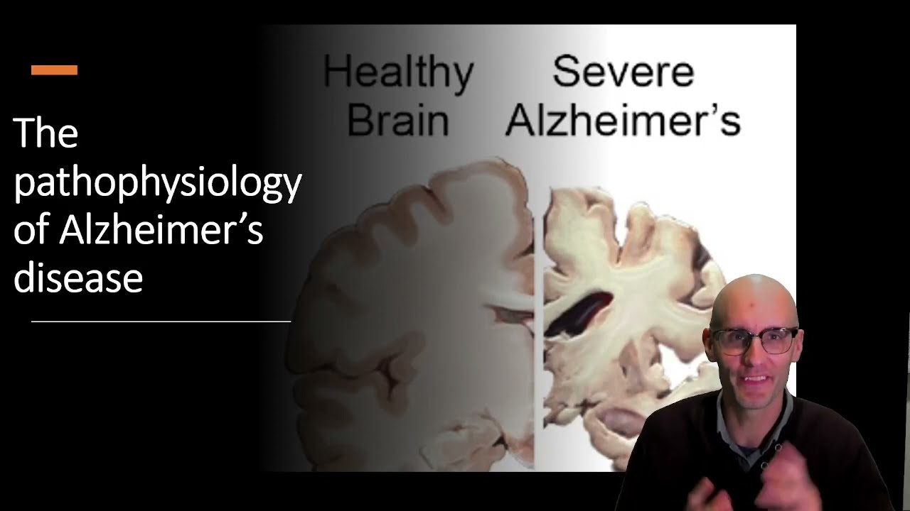 What causes Alzheimer's disease: The pathophysiology of Amyloid.