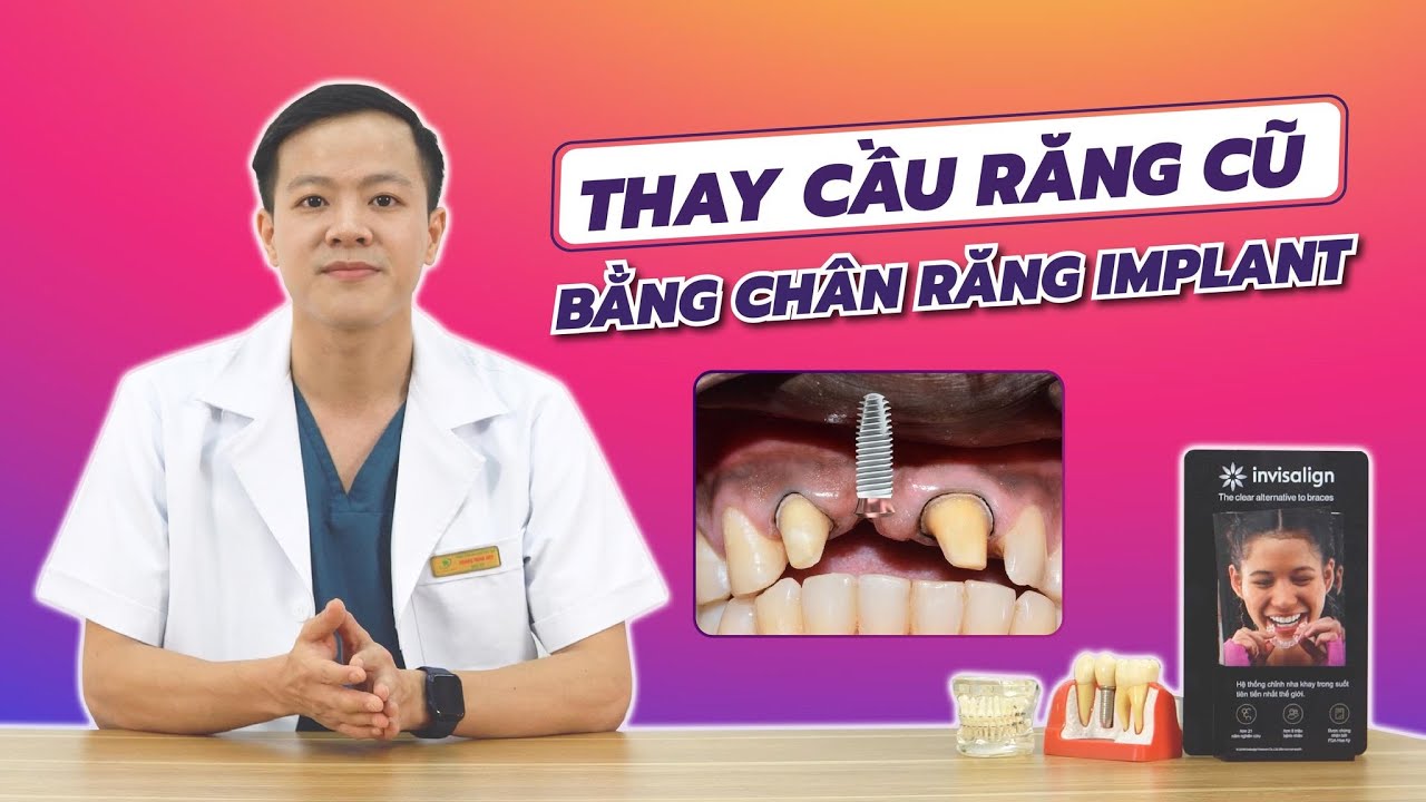 Outline Video Cách thay thế cầu răng cũ bằng chân răng nhân tạo Implant