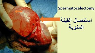 Spermatocelectomy استئصال القيلة المنوية