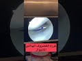 ازاي بخيط الغضروف الهلالي يدويا قصر العظام الدكتور أحمد نبيل رباط صليبي غضررف 