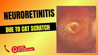 Neuroretinitis Due to Cat Scratch Disease: Diagnosis, Treatment & Clinical Pearls