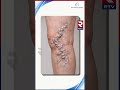 Avis Vascular Centre | Non Surgical Treatment | Best Varicose Veins Treatmen𝐭 | Avis Hospitals | RTV