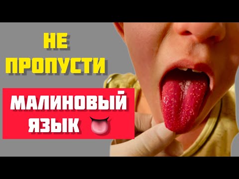 Video: Скарлатина менен скарлатина ортосунда айырма барбы?