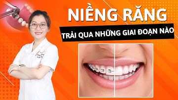 Niềng răng sẽ phải trải qua các giai đoạn nào? Có mấy giai đoạn |NKVA
