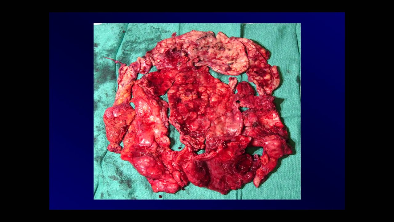 treatment of peritoneal mesothelioma