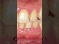 歯石除去と歯のクリーニングで取り戻す歯茎の健康