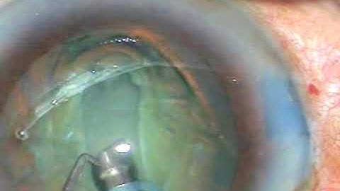 One of the BEST Videos to demonstrate "Divide and Conquer" Technique of Phacosurgery - PM, 27/10/17