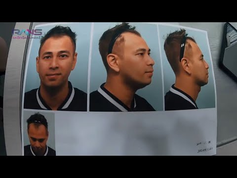 Video: Bekas Luka Transplantasi Rambut: Apakah Permanen Atau Bisakah Dihilangkan?