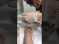 Hairy toes laserhairremoval hairytoes laser
